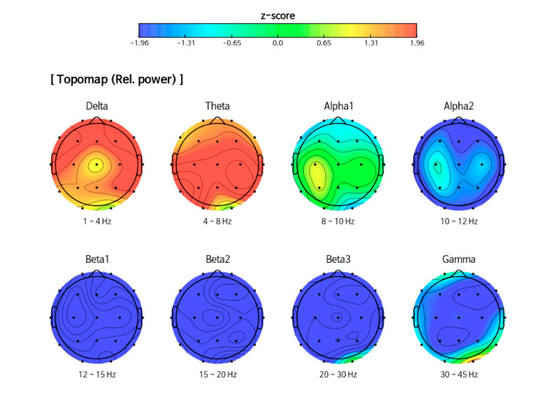 Mapa topográfico cerebral cuantitativo (qEEG)
