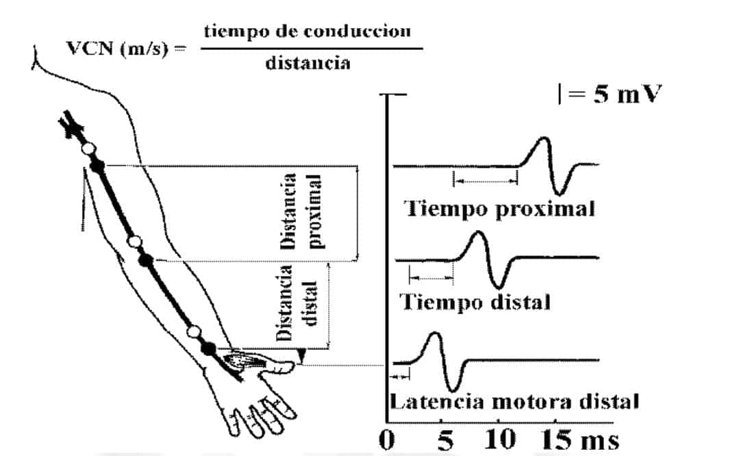 Equipo de Electromiografía y Conducción Nerviosa